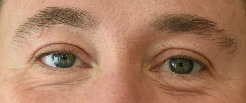 Eyelid Surgery Patient 7 Set 1 After